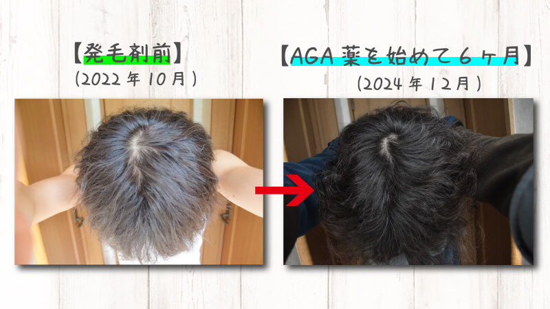 【薄毛（AGA）治療開始2年目】開始から11月現在までの効果を実感できた治療内容を2年分の写真で報告！ 